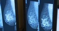 Fakultní nemocnice má nový mamograf